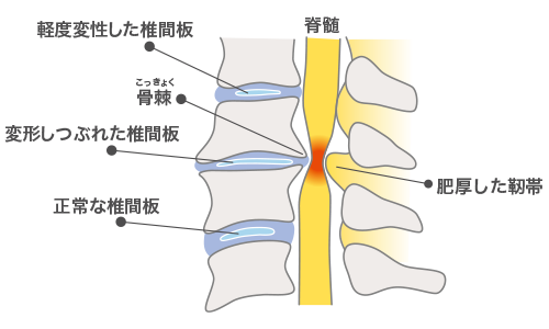 軽度変性した椎間板 骨棘 変形し潰れた椎間板 正常な椎間板 脊髄 肥厚した靭帯 棘突起 脊髄症