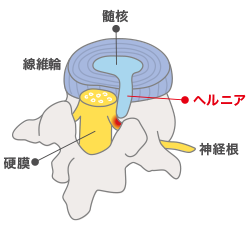 線維輪　髄核　ヘルニア　硬膜　神経根